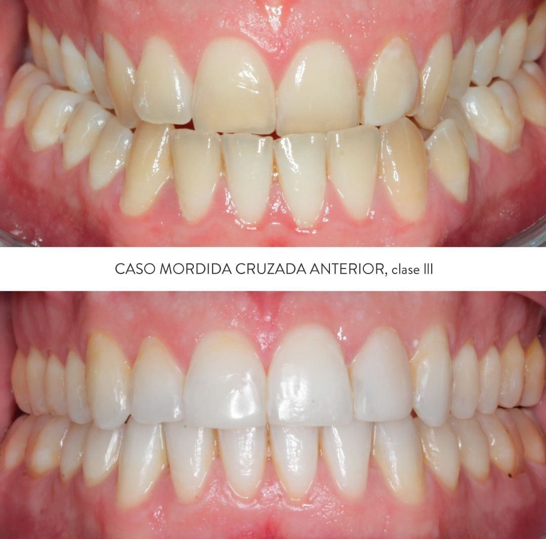 ortodoncia antes y despues