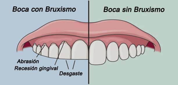 Bruxismo y ortodoncia, evita el desgaste dental